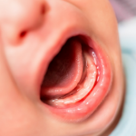 cara mengatasi sariawan pada bayi