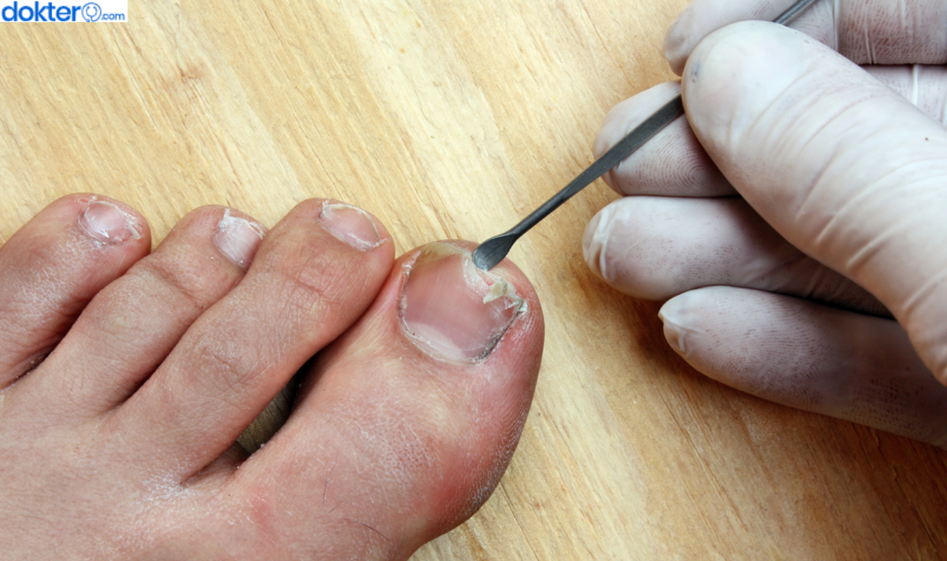 Cara Mengatasi Cantengan di Jempol Kaki