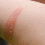 cara mengobati luka bakar knalpot anak