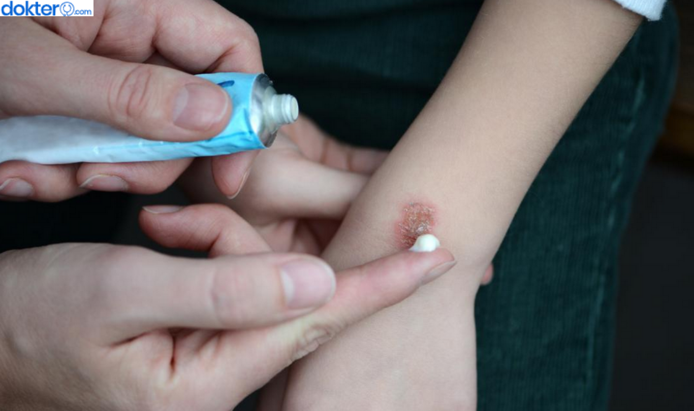 cara mengobati luka bakar knalpot anak