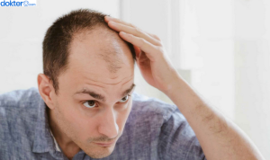 Cara Mengatasi Kebotakan Dini pada Pria