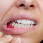 cara mengatasi gusi bengkak karena gigi bungsu