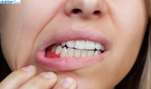 cara mengatasi gusi bengkak karena gigi bungsu