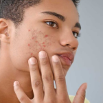 cara mengatasi jerawat hormonal pada pria