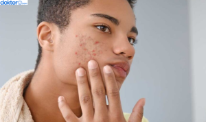 cara mengatasi jerawat hormonal pada pria