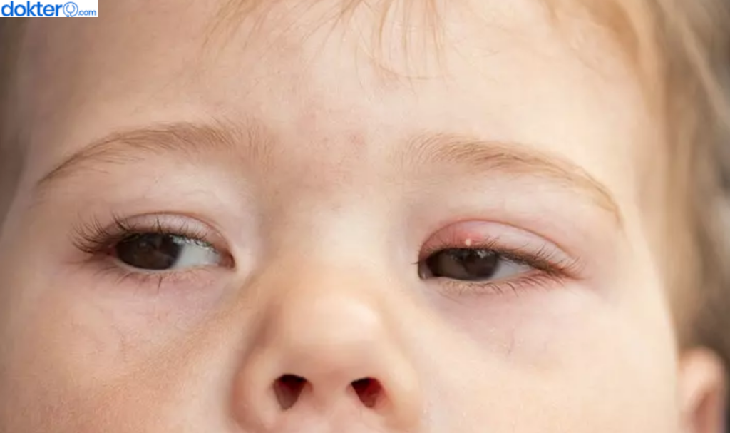 cara mengatasi mata bintitan pada anak