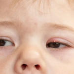 cara mengatasi mata bintitan pada anak