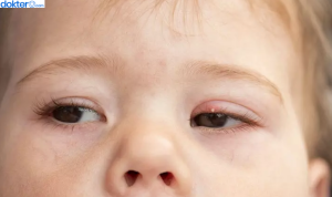 cara mengatasi mata bintitan pada anak