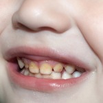 cara mengatasi gigi kuning pada anak