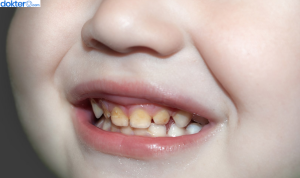 cara mengatasi gigi kuning pada anak