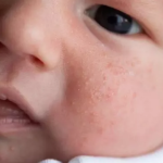 Cara Mengatasi Biang Keringat pada Bayi