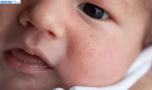 Cara Mengatasi Biang Keringat pada Bayi